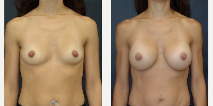 Woman treated with Breast Implants