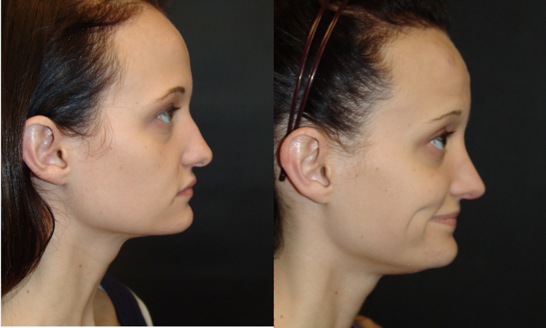 Woman treated with Rhinoplasty